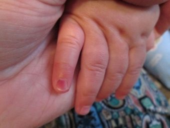 Trauma isi rumah pada kanak-kanak: apa yang harus dilakukan jika bayi telah mencubit jari?