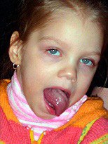 バルバー症候群：小児および成人の病因の原因、症状、治療の特徴