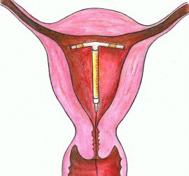 เป็นอันตรายต่อ endometriosis คืออะไร?