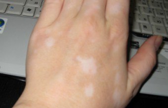 Hva skal jeg gjøre hvis tørr flekker vises på huden min?