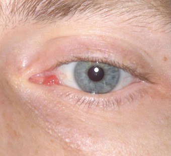 papilloma virus occhio