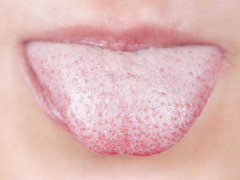 무엇이 혀의 붓기를 불러 일으킬 수 있습니까?