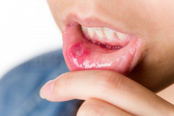 소아 구내염 : 원인과 치료