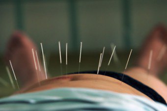 Niepłodność w akupunkturze: niekonwencjonalna, ale skuteczna metoda leczenia