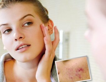 Hoe zich te ontdoen van littekens na acne?