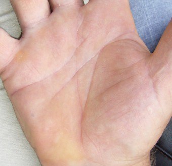 Come sbarazzarsi dei coni nel palmo della mano sotto la pelle?