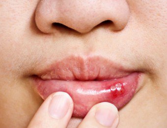 どのように私は私の口の中の私の傷を治すことができますか？