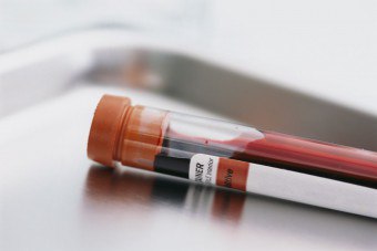Hvordan dechifiseres blodprøven for toksoplasmose?