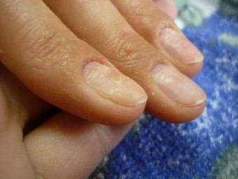 Cum de a identifica și vindeca distrofia unghiei?