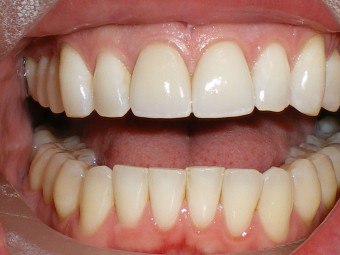 Калцијум за зубе: како надокнадити продавнице елемента у телу?