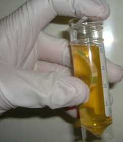 Ketonuri i svangerskapet: hvor farlig er veksten av aceton i urinen?