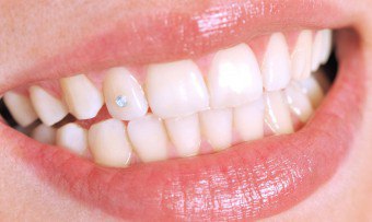 Kto może ozdabiać zęby kryształkami, aw jakich przypadkach nie należy tego robić?