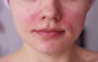 鼻の赤い斑点：戦う方法と排除する方法？