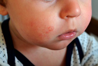 Rode vlekken op de wangen van het kind: de belangrijkste oorzaken van het uiterlijk en de preventiemethoden