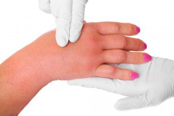 Lymphostasis av hånden etter fjerning av brystet: symptomer og behandling