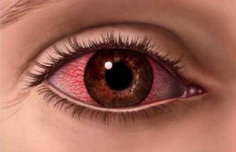 O capilar no olho estourou: as causas e conseqüências do defeito
