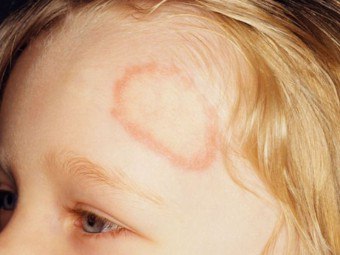 滑らかな皮膚と頭皮の微小胞子：症状と治療