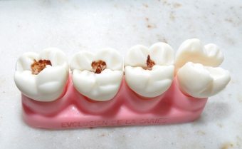 Môže sa zubný kaz spracovať bez vŕtania a vŕtania?