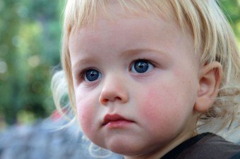 Piele de marmură la un copil: care este motivul?