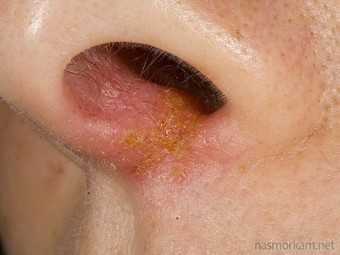 Sores terbentuk di hidung: apa yang perlu dirawat?