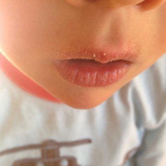Bibir atas bengkak - bagaimana untuk merawat dan penyebab kesakitan