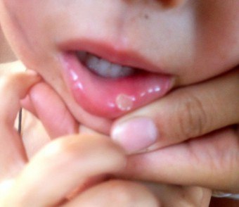 Svullen övre läpp - hur man behandlar och orsakerna till smärta