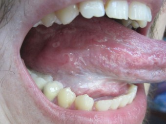 Waarom doet de wortel van de tong pijn?