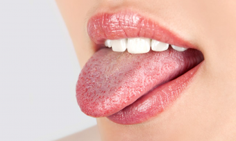 Varför skadar rodan på tungan?