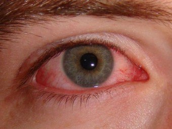 Prečo červené oči a čo s tým robiť?
