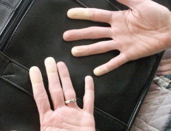 Varför förekommer peeling mellan fingrarna? Orsakerna till sjukdomen och sätt att bli av med det
