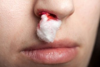 Raudonos nosies priežastys ir gydymo būdai