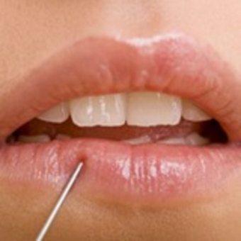 Orsaker till läpparnas domningar: finns det en patologisk process?