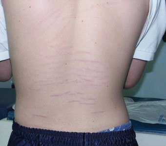 De oorzaken van striae op de rug bij adolescenten, hun behandeling en preventie