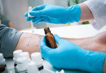 Alergenų tyrimai: odos tyrimai ir laboratorinė diagnostika