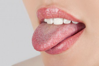 Bubliny v ústnej dutine a v jazyku sú defektom alebo príznakom ochorenia?