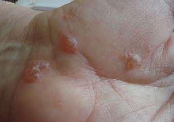 Bubbler på håndflatene: årsaker og metoder for behandling