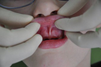 Ruptura frenului: tratamentul patologiei buzelor superioare și inferioare