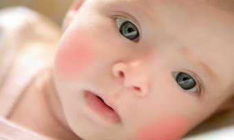 الجلد الخام في الطفل - القاعدة أو الانحراف؟