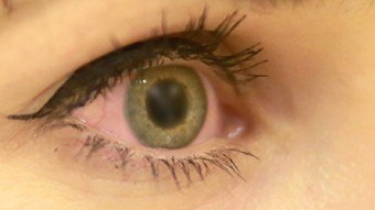 目の中の虫の症状と治療