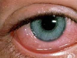 目の中の虫の症状と治療