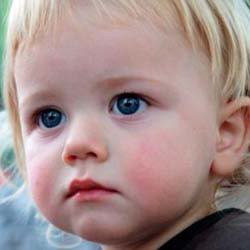 顔の血管網 - 子供を助ける方法？