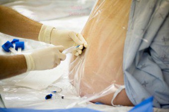 Спинална анестезија: суштина методе, зашто, коме и када се примјењује