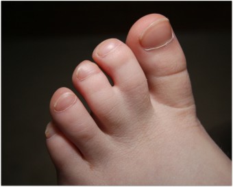 Jari kaki di kaki: apa maksudnya dan apakah sebab-sebab kejadian sindactyly