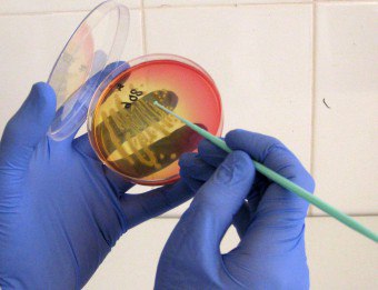 女性の塗抹標本での連鎖球菌（Staphylococcus a Streptococcus）