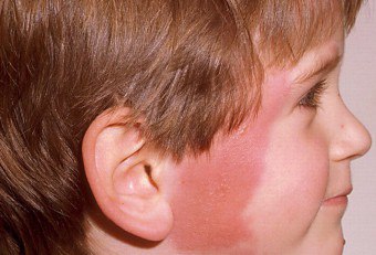 Streptokoková infekcia u dieťaťa: typy ochorení a spôsoby ich liečby