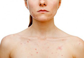 نقاط على بطن اللون الأحمر - مشاكل صحية أو عيب مستحضرات التجميل؟