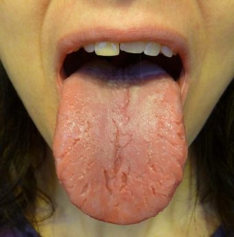Trhliny a biely povlak na jazyku - príčiny, symptómy, liečba