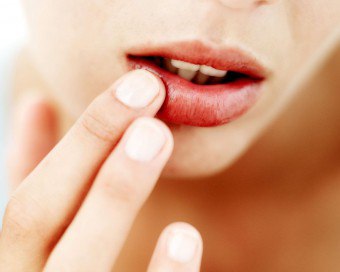 Sprickande och fläckande läppar - vad är orsaken?
