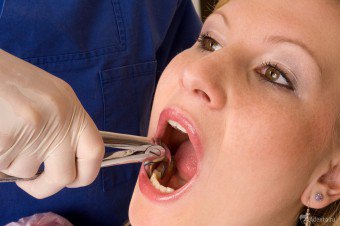 Pembuangan molar: apa yang penuh dan apa yang perlu dilakukan oleh pesakit?