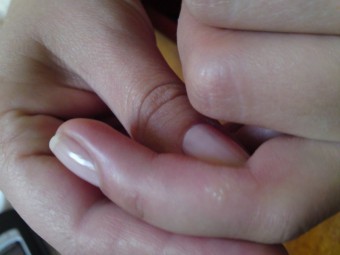 Blistere pe degete: cum să aflăm cauza și să tratăm?